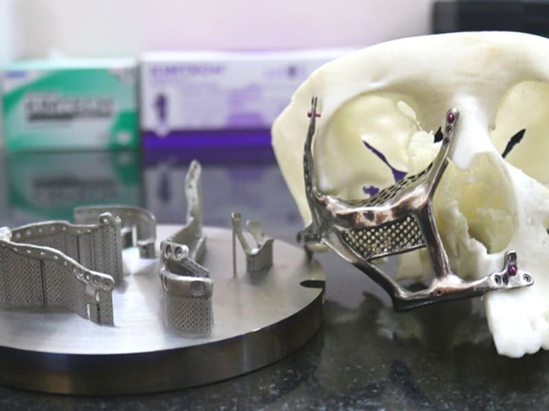 3D-Printed Face Implants: A Transformative Solution for Black Fungus Survivors in India